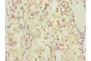 Immunohistochemistry of paraffin-embedded human gastric cancer using ABIN7149316 at dilution of 1:100 (DYNC1I1 anticorps  (AA 1-220))