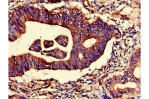 Immunohistochemistry of paraffin-embedded human colon cancer using ABIN7151278 at dilution of 1:100