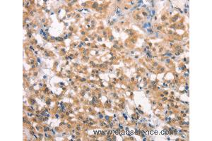 Immunohistochemistry of Human liver cancer using LATS2 Polyclonal Antibody at dilution of 1:30 (LATS2 anticorps)