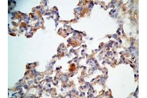 Rat lung cancer tissue stained by Rabbit Anti-CRAMP (Mouse) Antibody