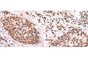 Immunohistochemistry of paraffin-embedded Human esophagus cancer tissue using SF3B3 Polyclonal Antibody at dilution of 1:70(x200)