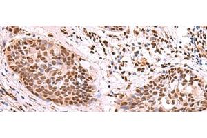 Immunohistochemistry of paraffin-embedded Human esophagus cancer tissue using SF3B3 Polyclonal Antibody at dilution of 1:70(x200) (SF3B3 anticorps)