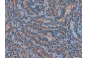 Detection of COL4a1 in Human Thyroid cancer Tissue using Polyclonal Antibody to Collagen Type IV Alpha 1 (COL4a1)