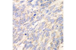 Immunohistochemistry of paraffin-embedded human esophageal cancer using DLD antibody. (DLD anticorps  (AA 36-300))