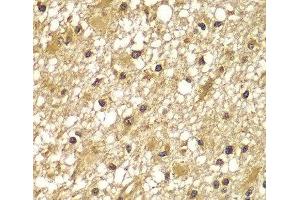Immunohistochemistry of paraffin-embedded Human brain cancer using PIK3R3 Polyclonal Antibody at dilution of 1:100 (40x lens).