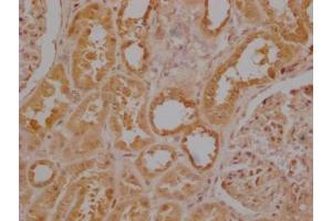 Immunohistochemistry of paraffin-embedded human colon cancer using ABIN7174308 at dilution of 1:100 (USP3 anticorps  (C-Term))
