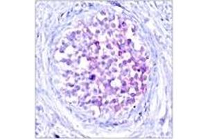 Immunohistochemistry analysis of paraffin-embedded human breast carcinoma, using C-RAF (Phospho-Ser259) Antibody. (RAF1 anticorps  (AA 225-274))