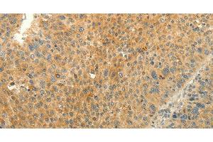 Immunohistochemistry of paraffin-embedded Human liver cancer tissue using EDG7 Polyclonal Antibody at dilution 1:40 (LPAR3 anticorps)