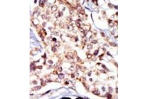 Formalin-fixed and paraffin-embedded human cancer tissue reacted with the primary antibody, which was peroxidase-conjugated to the secondary antibody, followed by DAB staining.