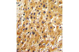 Formalin-fixed and paraffin-embedded human hepatocarcinoma with RT Antibody (N-term), which was peroxidase-conjugated to the secondary antibody, followed by DAB staining. (APRT anticorps  (N-Term))