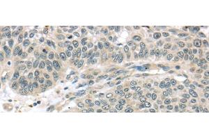 Immunohistochemistry of paraffin-embedded Human lung cancer using THAP4 Polyclonal Antibody at dilution of 1/30