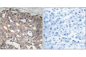 Immunohistochemistry analysis of paraffin-embedded human breast carcinoma tissue, using STMN1 (Ab-62) Antibody. (Stathmin 1 anticorps  (AA 26-75))