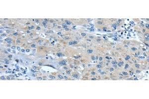 Immunohistochemistry of paraffin-embedded Human liver cancer using TNIP1 Polyclonal Antibody at dilution of 1/35 (TNIP1 anticorps)