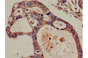 Immunohistochemistry of paraffin-embedded human pancreatic cancer using ABIN7152297 at dilution of 1:100 (DIS3 anticorps  (AA 30-187))