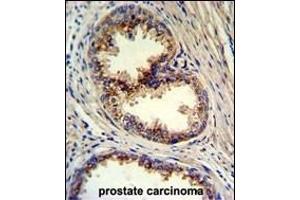 Formalin-fixed and paraffin-embedded human prostate carcinoma reacted with GOLPH3 Antibody (N-term), which was peroxidase-conjugated to the secondary antibody, followed by DAB staining.