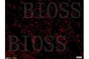 Formalin-fixed and paraffin-embedded human colon carcinoma labeled with Anti-ADAMTS1 Polyclonal Antibody, Unconjugated (ABIN673404) 1:200, overnight at 4°C, The secondary antibody was Goat Anti-Rabbit IgG, Cy3 conjugated used at 1:200 dilution for 40 minutes at 37°C.