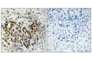 Immunohistochemistry analysis of paraffin-embedded human breast carcinoma tissue, using IRX3 antibody. (IRX3 anticorps)