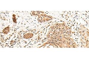 Immunohistochemistry of paraffin-embedded Human esophagus cancer tissue using KCTD13 Polyclonal Antibody at dilution of 1:55(x200) (KCTD13 anticorps)
