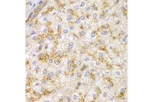 Immunohistochemistry of paraffin-embedded human liver cancer using ACTN1 antibody.