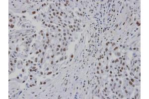IHC-P Image Immunohistochemical analysis of paraffin-embedded human lung cancer patient tumor, using RPA 14 kDa subunit , antibody at 1:100 dilution.
