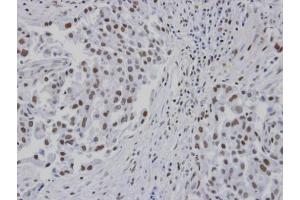 IHC-P Image Immunohistochemical analysis of paraffin-embedded human lung cancer patient tumor, using RPA 14 kDa subunit , antibody at 1:100 dilution. (RPA3 anticorps)