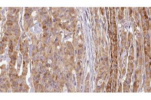 ABIN6267114 at 1/100 staining Human thyroid cancer tissue by IHC-P. (EEF2K anticorps  (pSer366))