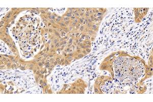 Detection of SQSTM1 in Human Lung cancer Tissue using Polyclonal Antibody to Sequestosome 1 (SQSTM1)
