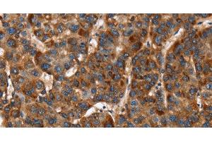 Immunohistochemistry of paraffin-embedded Human liver cancer tissue using CACNB2 Polyclonal Antibody at dilution 1:30