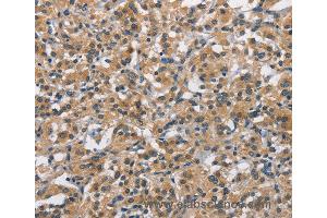 Immunohistochemistry of Human thyroid cancer using APOL1 Polyclonal Antibody at dilution of 1:40 (APOL1 anticorps)