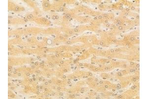 ABIN7097165 and ABIN7101233 at 1/100 staining human hepatocellular carcinoma by IHC-P. (XYLB anticorps)