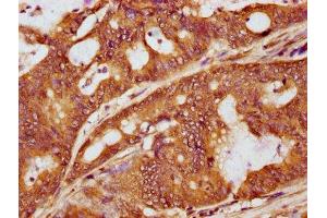 IHC image of ABIN7127705 diluted at 1:100 and staining in paraffin-embedded human colon cancer performed on a Leica BondTM system.