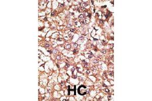Formalin-fixed and paraffin-embedded human hepatocellular carcinoma tissue reacted with STUB1 polyclonal antibody  , which was peroxidase-conjugated to the secondary antibody, followed by AEC staining. (STUB1 anticorps  (AA 160-190))