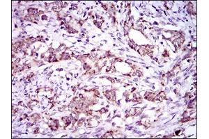 Immunohistochemical analysis of paraffin-embedded cervical cancer tissues using DNAL4 mouse mAb with DAB staining. (DNAL4 anticorps  (AA 1-105))