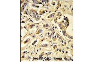 Formalin-fixed and paraffin-embedded human breast carcinoma reacted with VGFR1 Antibody, which was peroxidase-conjugated to the secondary antibody, followed by DAB staining.