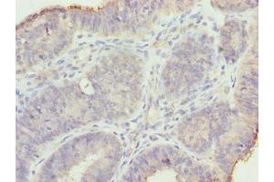 Immunohistochemistry of paraffin-embedded human endometrial cancer using ABIN7159191 at dilution of 1:100 (MND1 anticorps  (AA 2-205))