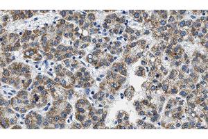 ABIN6276063 at 1/100 staining Human liver cancer tissue by IHC-P. (NPY5R anticorps  (Internal Region))