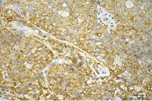 Immunohistochemistry was performed on paraffin-embedded human breast carcinoma using STAT1 antibody (ABIN7800336), 1:200). (Recombinant STAT1 anticorps)