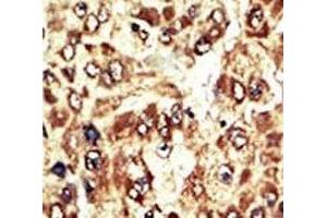 IHC analysis of FFPE human hepatocarcinoma tissue stained with the WEE1 antibody