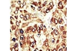 IHC analysis of FFPE human hepatocarcinoma tissue stained with the WEE1 antibody (WEE1 anticorps  (AA 604-634))