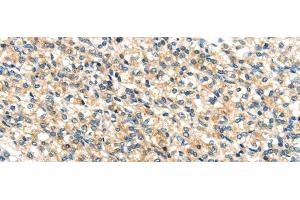 Immunohistochemistry of paraffin-embedded Human prostate cancer tissue using TTI1 Polyclonal Antibody at dilution 1:40 (TTI1 anticorps)