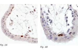 Immunohistochemistry (IHC) image for anti-Tumor Protein P53 (TP53) (AA 378-393), (C-Term), (pSer392) antibody (ABIN238404) (p53 anticorps  (C-Term, pSer392))
