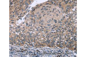 Immunohistochemistry of Human cervical cancer using RNF144B Polyclonal Antibody at dilution of 1:50
