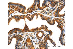 Immunohistochemistry of Human thyroid cancer using SPARC Polyclonal Antibody at dilution of 1:25 (SPARC anticorps)