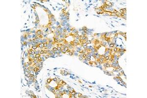 Immunohistochemistry of paraffin embedded human breast cancer using Epl4 (ABIN7073843) at dilution of 1:2000 (400x lens) (EFNA4 anticorps)