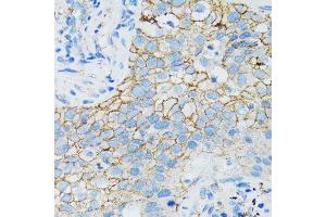 Immunohistochemistry of paraffin-embedded human lung cancer using CTNNA1 antibody.
