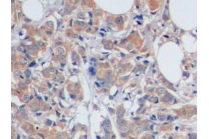Detection of CA125 in Human Breast cancer Tissue using Polyclonal Antibody to Carbohydrate Antigen 125 (CA125)