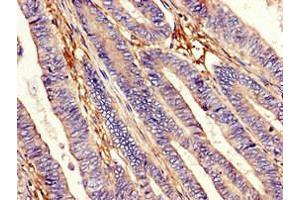 Immunohistochemistry of paraffin-embedded human colon cancer using ABIN7151326 at dilution of 1:100 (EEA1 anticorps  (AA 734-875))