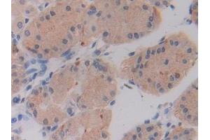 Detection of SHMT2 in Human Stomach cancer Tissue using Polyclonal Antibody to Serine Hydroxymethyltransferase 2, Mitochondrial (SHMT2)