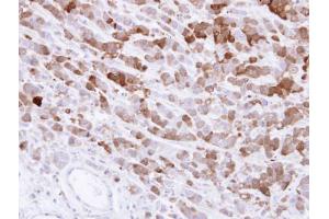 IHC-P Image Immunohistochemical analysis of paraffin-embedded MDA-MB-468 xenograft , using AKR1C1, antibody at 1:500 dilution.