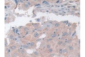 Detection of ASAH1 in Human Breast cancer Tissue using Polyclonal Antibody to N-Acylsphingosine Amidohydrolase 1 (ASAH1) (ASAH1 anticorps  (AA 144-395))